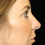 Primary Rhinoplasty Before & After Patient #12109