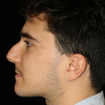 Primary Rhinoplasty Before & After Patient #12104