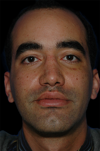 Primary Rhinoplasty Before & After Patient #12114