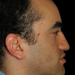 Primary Rhinoplasty Before & After Patient #12114