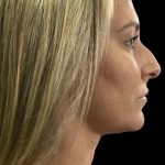 Non-Surgical Rhinoplasty Before & After Patient #12232