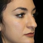 Secondary Rhinoplasty Before & After Patient #12207