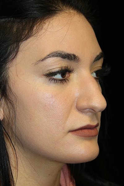 Secondary Rhinoplasty Before & After Patient #12207