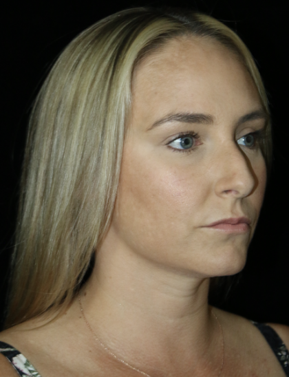 Non-Surgical Rhinoplasty Before & After Patient #12232