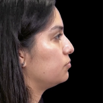 Non-Surgical Rhinoplasty Before & After Patient #12261