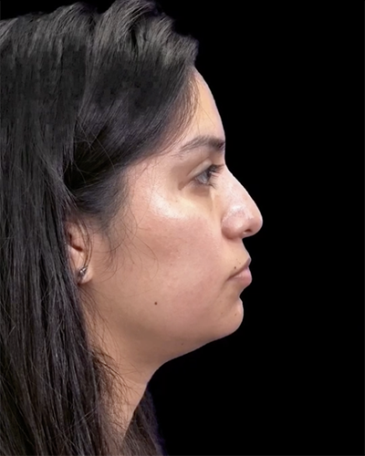 Non-Surgical Rhinoplasty Before & After Patient #12261