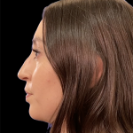 Non-Surgical Rhinoplasty Before & After Patient #12264