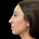 Non-Surgical Rhinoplasty Before & After Patient #12264