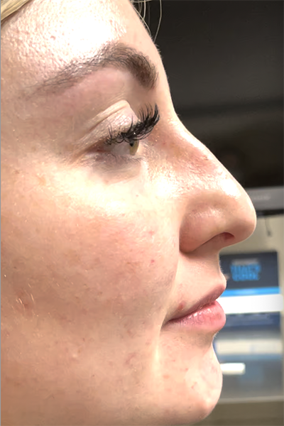 Non-Surgical Rhinoplasty Before & After Patient #12267