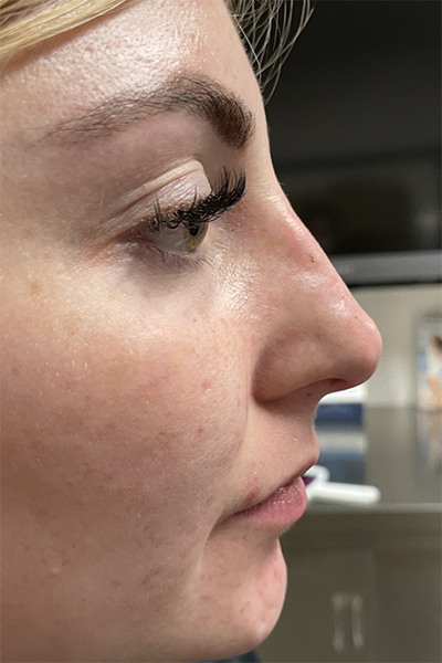Non-Surgical Rhinoplasty Before & After Patient #12267