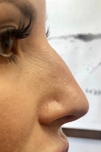 Non-Surgical Rhinoplasty Before & After Patient #12237