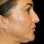 Non-Surgical Rhinoplasty Before & After Patient #12240