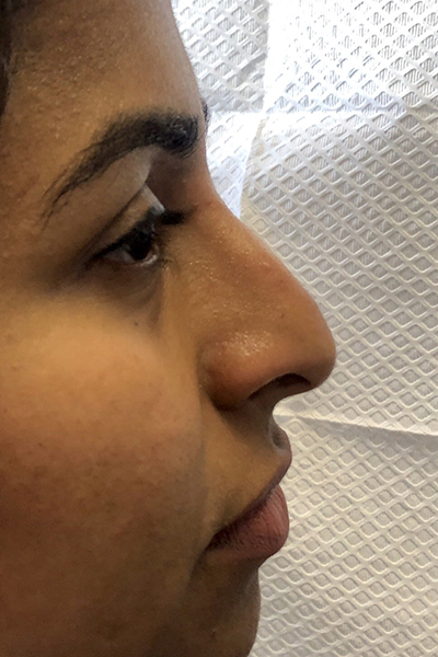 Non-Surgical Rhinoplasty Before & After Patient #12243