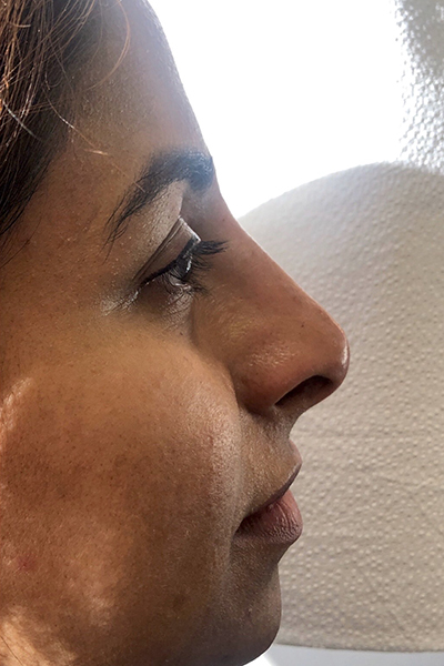 Non-Surgical Rhinoplasty Before & After Patient #12243