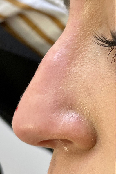 Non-Surgical Rhinoplasty Before & After Patient #12249