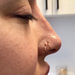 Non-Surgical Rhinoplasty Before & After Patient #12252