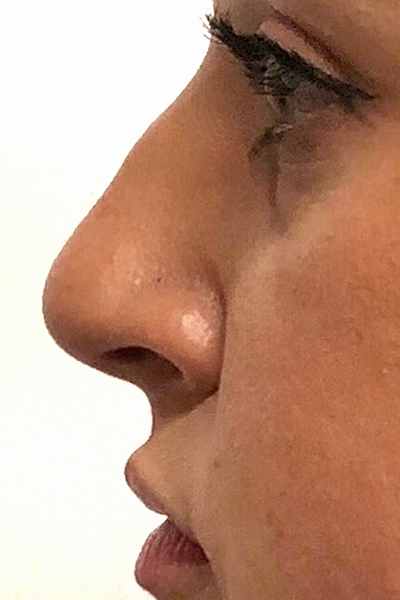 Non-Surgical Rhinoplasty Before & After Patient #12255