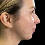 Non-Surgical Rhinoplasty Before & After Patient #12258