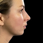 Non-Surgical Rhinoplasty Before & After Patient #12258