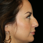 Primary Rhinoplasty Before & After Patient #12277