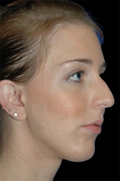 Primary Rhinoplasty Before & After Patient #12197