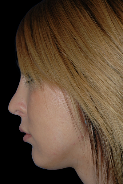 Primary Rhinoplasty Before & After Patient #12197