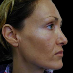 Reconstructive Rhinoplasty Before & After Patient #12220