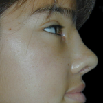 Reconstructive Rhinoplasty Before & After Patient #12228