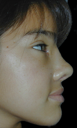 Reconstructive Rhinoplasty Before & After Patient #12228