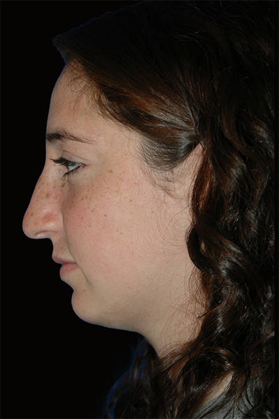 Primary Rhinoplasty Before & After Patient #12202