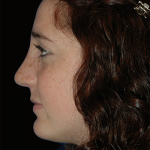 Primary Rhinoplasty Before & After Patient #12202