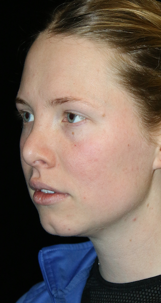 Secondary Rhinoplasty Before & After Patient #12215