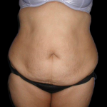 Tummy Tuck Before & After Patient #12080