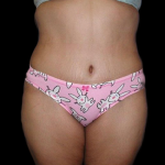 Tummy Tuck Before & After Patient #12080
