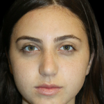 Primary Rhinoplasty Before & After Patient #12398