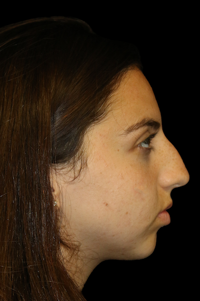 Primary Rhinoplasty Before & After Patient #12398