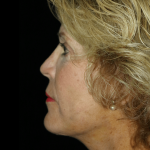 Facelift Before & After Patient #12409