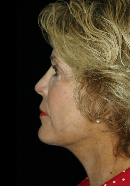 Facelift Before & After Patient #12409
