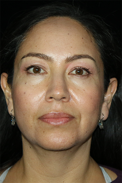 Facial Fat Grafting Before & After Patient #12510