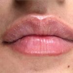 lip filler Before & After Patient #12519