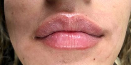 lip filler Before & After Patient #12519
