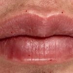 lip filler Before & After Patient #12516
