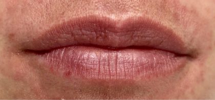 lip filler Before & After Patient #12516