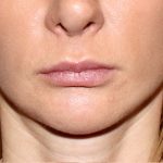 lip filler Before & After Patient #12522