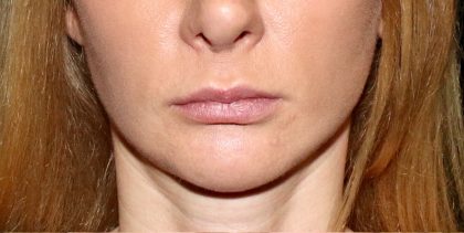 lip filler Before & After Patient #12522