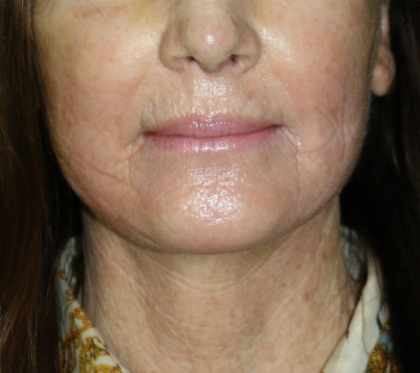 Facelift Before & After Patient #12547