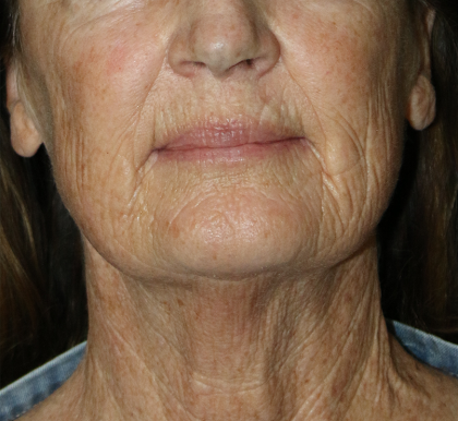 Facelift Before & After Patient #12547