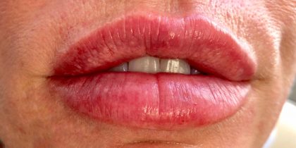 lip filler Before & After Patient #12525
