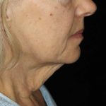 Facelift Before & After Patient #12582