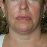 Facelift Before & After Patient #12611